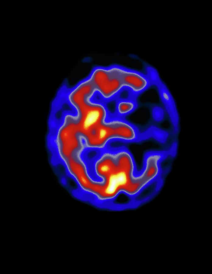 Coloured Pet Scan Of The Brain Of A Stroke Patient #2 Photograph by Dept. Of Nuclear Medicine, Charing Cross Hospital/science Photo Library