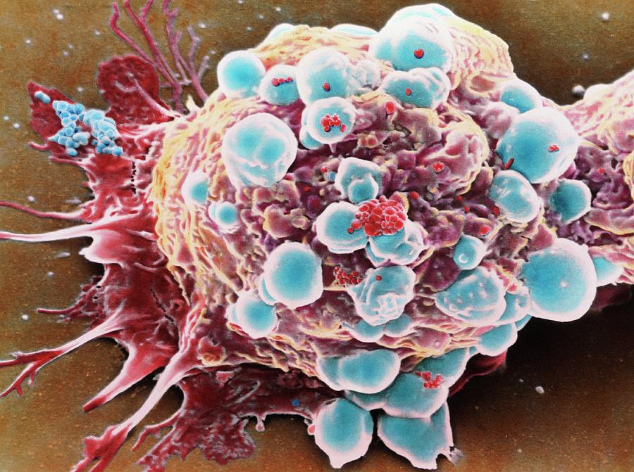 Coloured Sem Of A Breast Cancer Cell Photograph By Steve Gschmeissner Science Photo Library