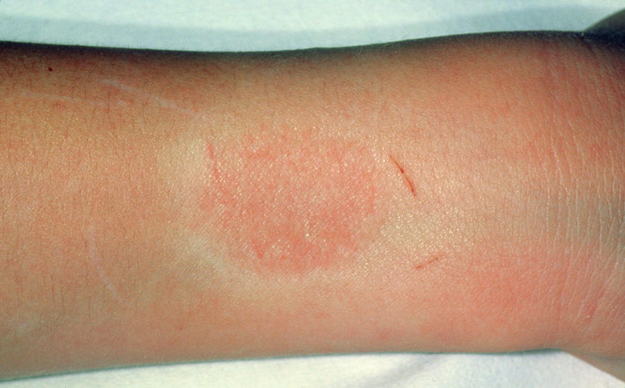 Contact Dermatitis Wristwatch Allergy Photograph By Dr P Marazzi