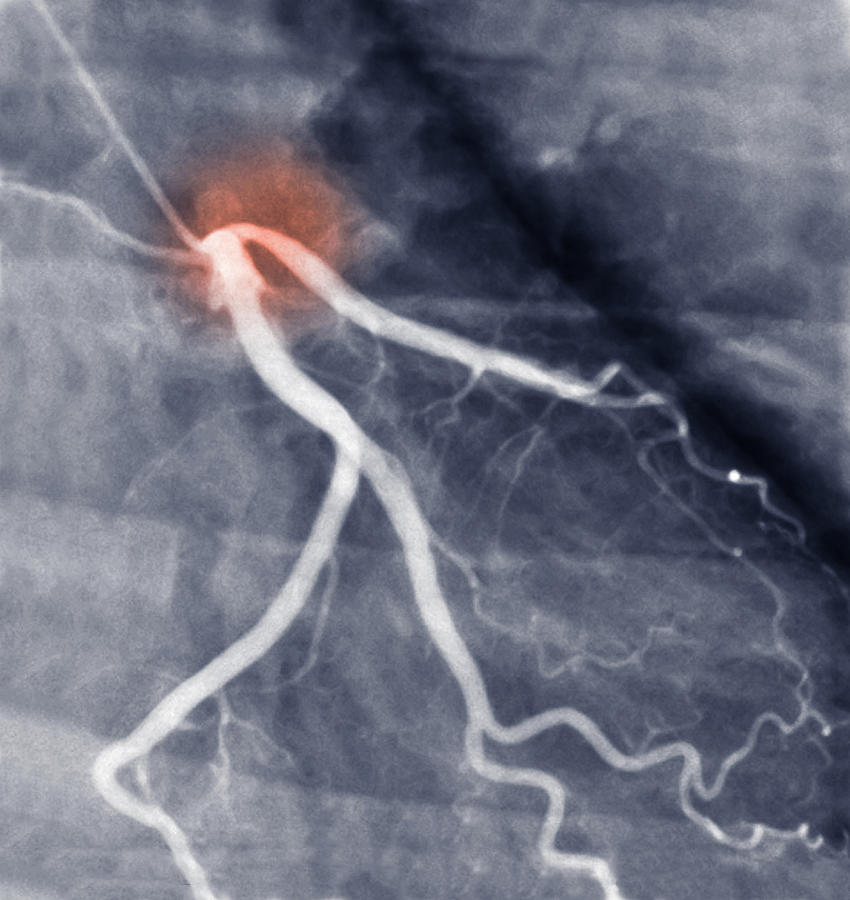Coronary Artery Disease #2 Photograph by Voisin/Phanie