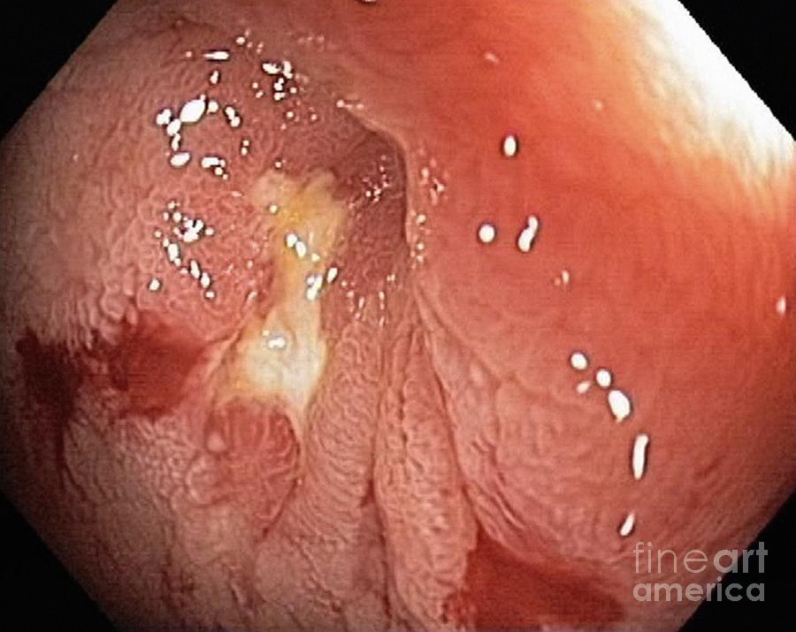 Digestive System Photograph - Crohns Disease, Endoscopic View #2 by Gastrolab
