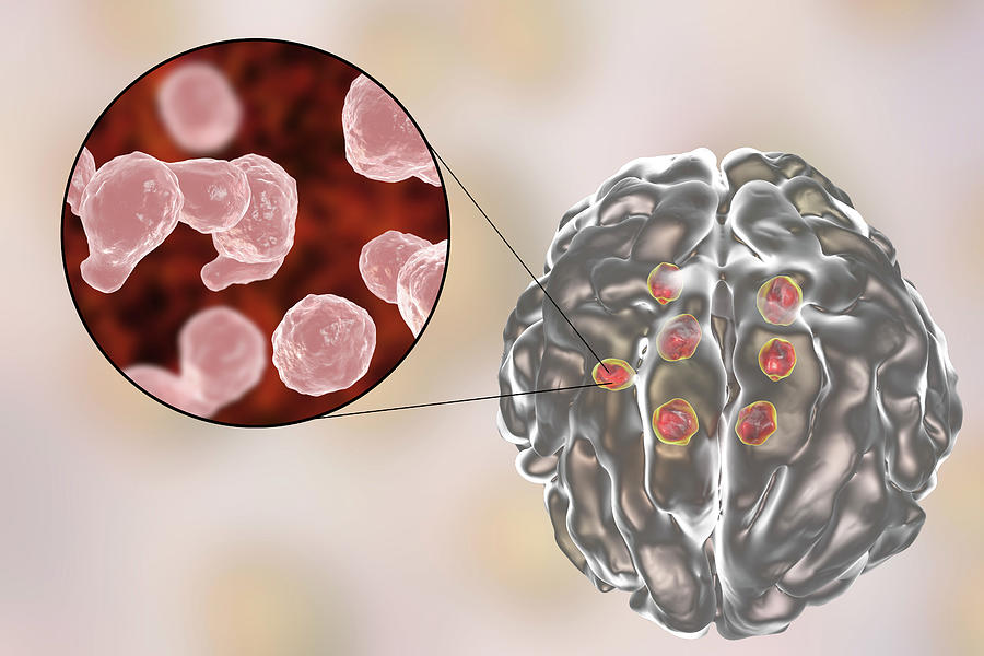 Cryptococcal Brain Lesions #2 by Kateryna Kon/science Photo Library