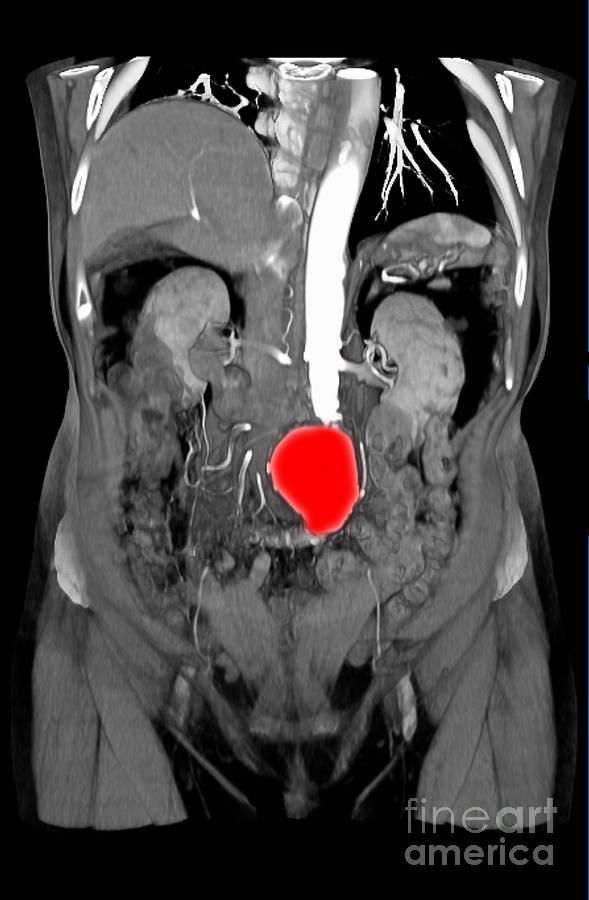 Ct Scan Of Abdominal Aortic Aneurysm #2 Photograph by Scott Camazine