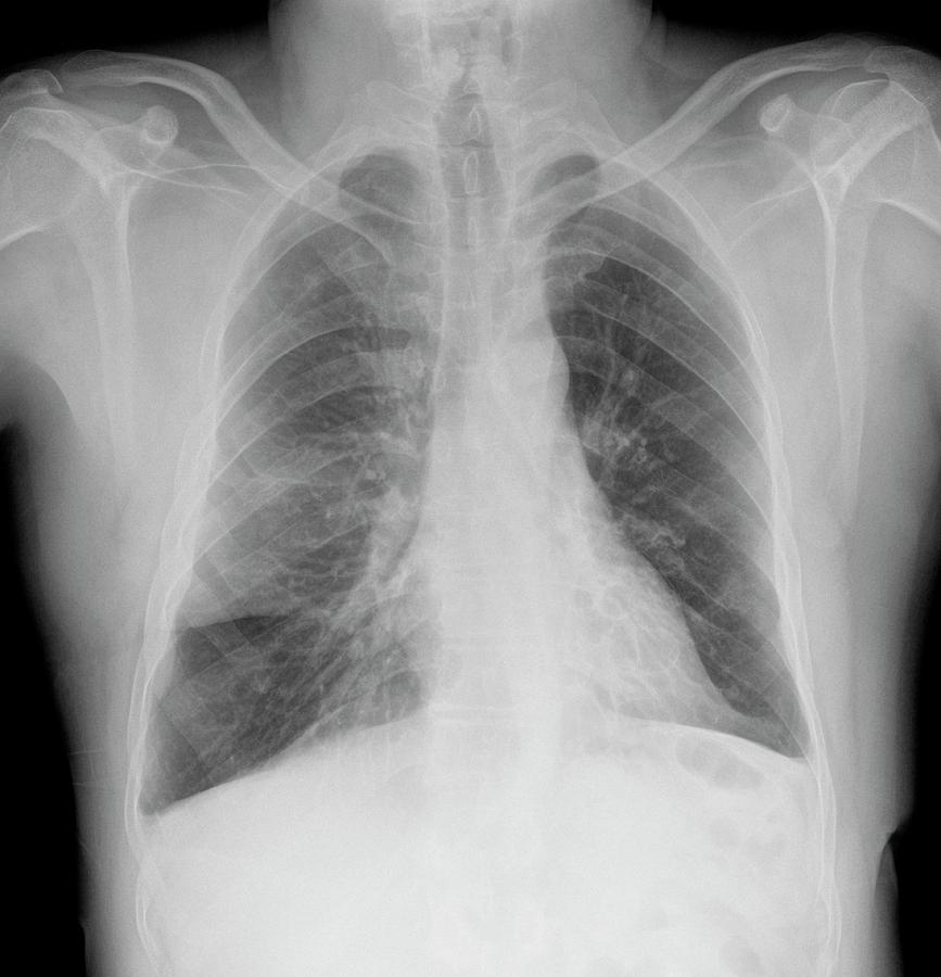 Cystic Fibrosis Photograph by Photostock-israel/science Photo Library ...