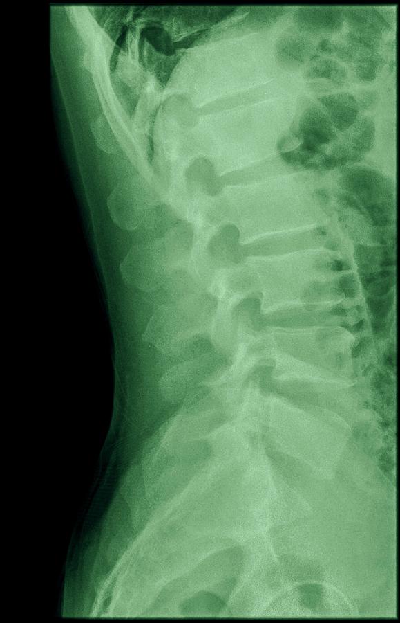 Dens Fracture. Cervical Spine X-ray #2 by Photostock-israel