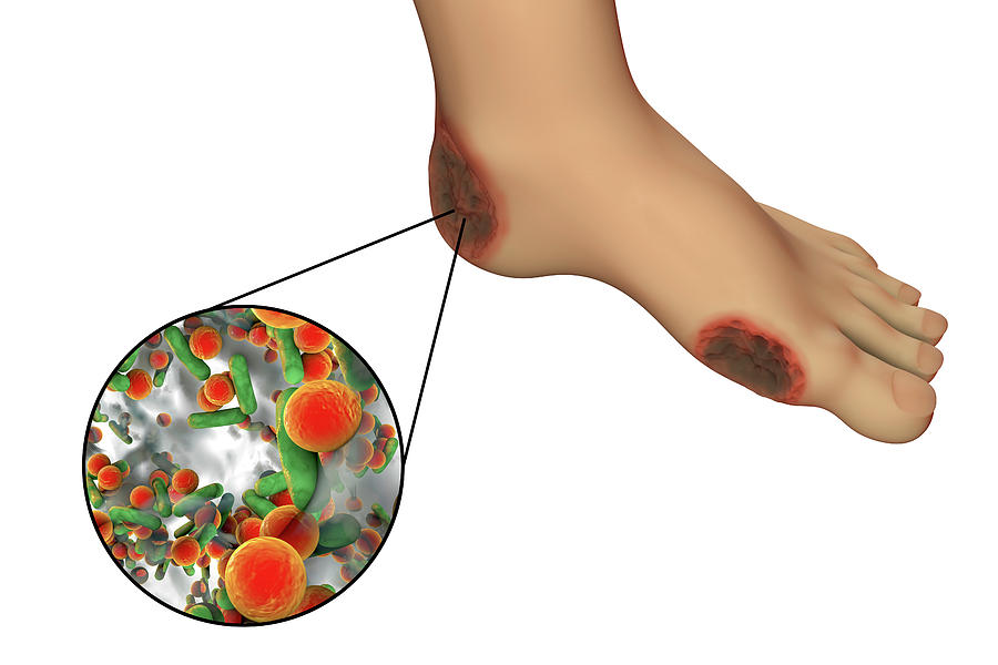 Diabetic Foot Infection Photograph by Kateryna Kon/science ...