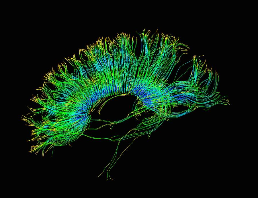 Diffusion MRI, also referred to as diffusion tensor imaging or DTI, of the human brain Photograph by Callista Images