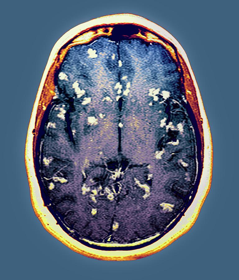 Diseased Brain Photograph by Zephyr/science Photo Library - Fine Art ...