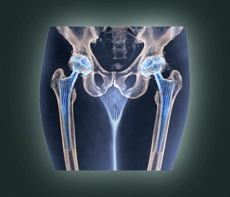 https://images.fineartamerica.com/images-medium-large-5/2-double-hip-replacement-zephyr.jpg