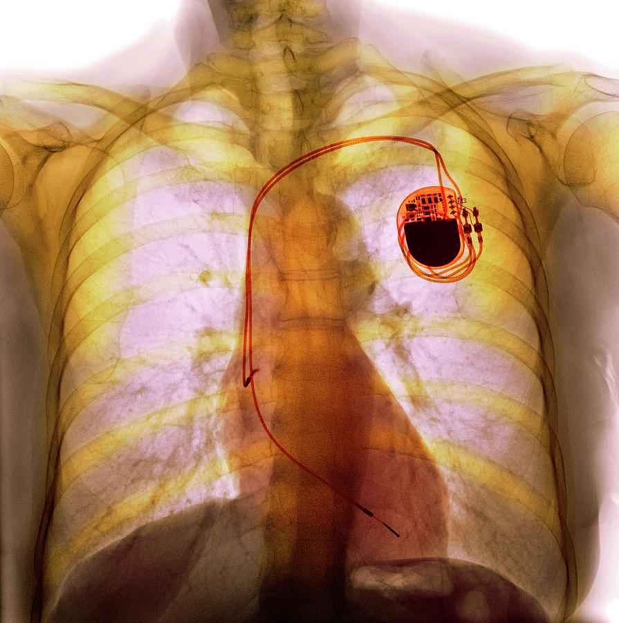 Dual Chamber Pacemaker By Science Photo Library