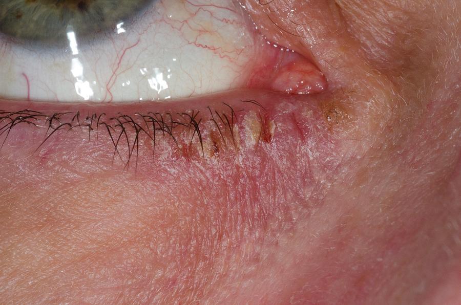 Eczema Around The Eye Photograph By Dr P Marazzi Science Photo Library