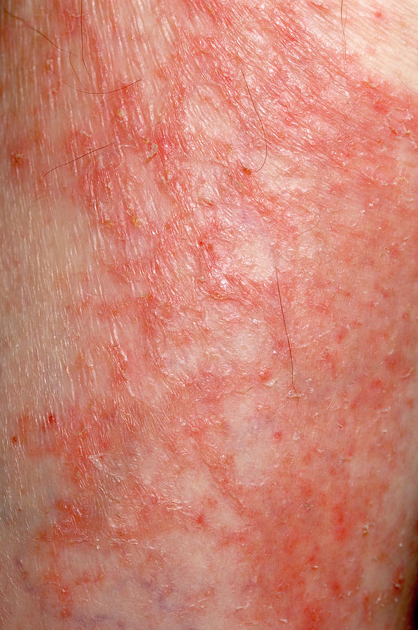 Eczema Photograph By Dr P Marazziscience Photo Library