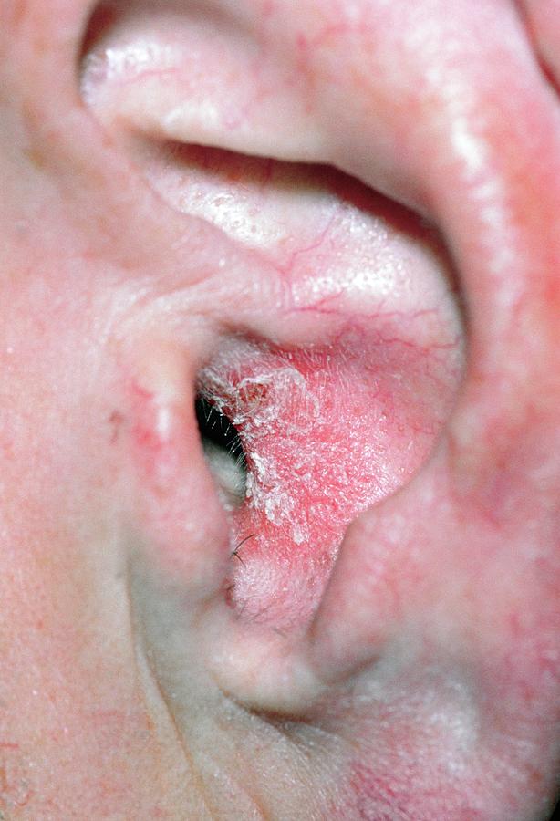 Eczema In The Ear Canal Photograph By Dr P Marazzi Science Photo Library