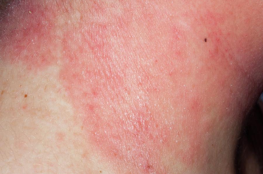 Eczema On The Neck Photograph By Dr P Marazzi Science Photo Library