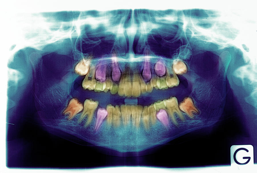 Emergence Of Adult Teeth #2 Photograph by Alex Bartel/science Photo Library