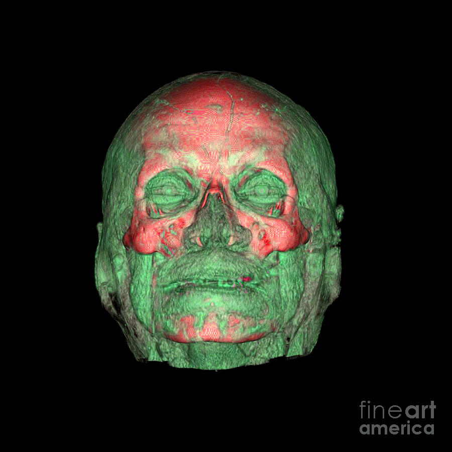 Enhanced 3d Ct Of Face And Skull #2 Photograph by Living Art Enterprises