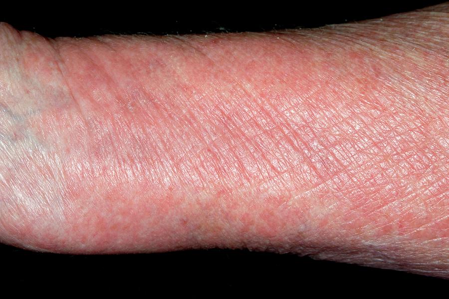 Exfoliative Dermatitis Photograph By Dr P Marazzi Science Photo Library