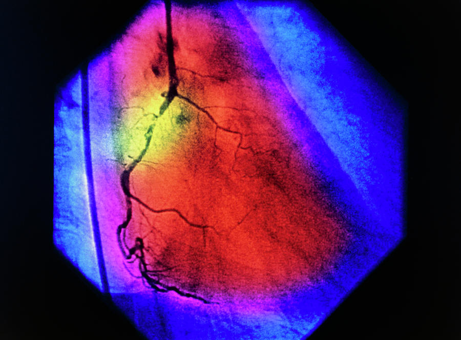False-colour Coronary Angiogram: Stenosis #2 Photograph by Mehau Kulyk/science Photo Library