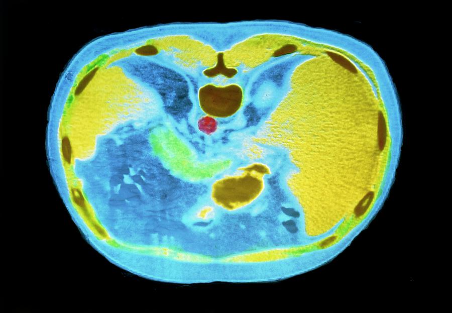 False-colour Ct Scan Of Liver #2 Photograph by Alain Pol, Ism/science Photo Library