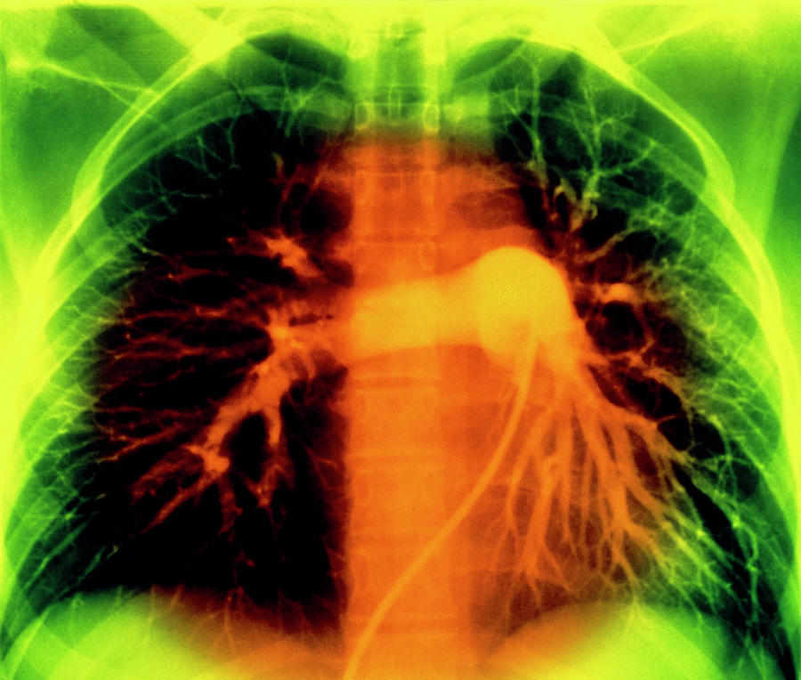 False-colour Normal Pulmonary Arteriogram #2 Photograph by Mehau Kulyk/science Photo Library