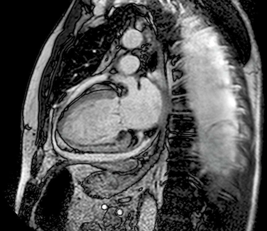 Fluid Around Heart In Heart Failure Photograph by Zephyr/science Photo ...