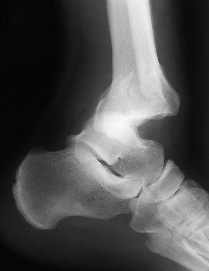 Black And White Photograph - Fractured Ankle #2 by Zephyr