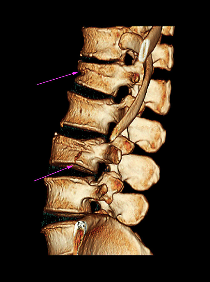 Fractured Spine Photograph by Zephyr/science Photo Library - Fine Art ...