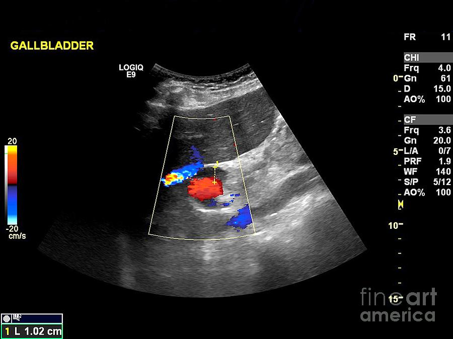 Gallstone Ultrasound Scan Photograph By Science Photo Library Fine ...