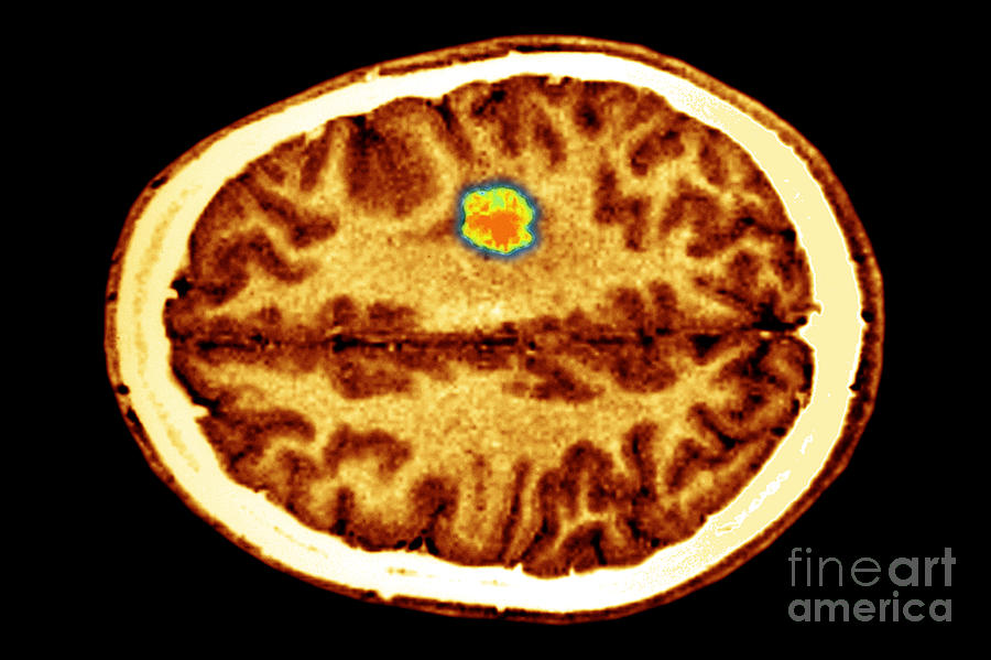 Glioma Brain Tumor #2 Photograph by Scott Camazine