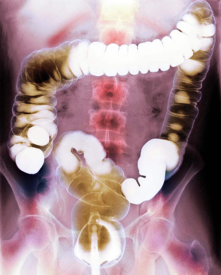 Colon Photograph - Healthy Colon #2 by Medimage/science Photo Library