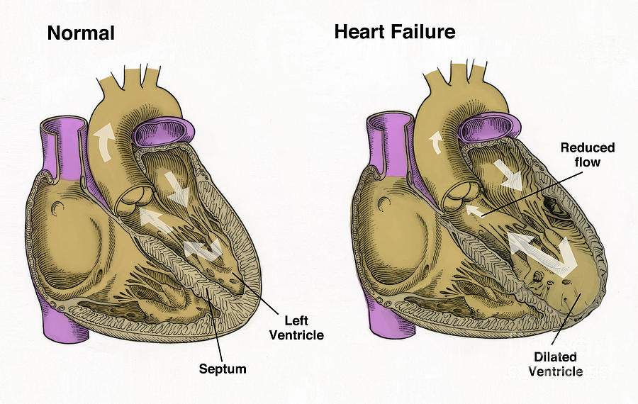 Healthy Heart Vs. Heart Failure Photograph by Spencer Sutton