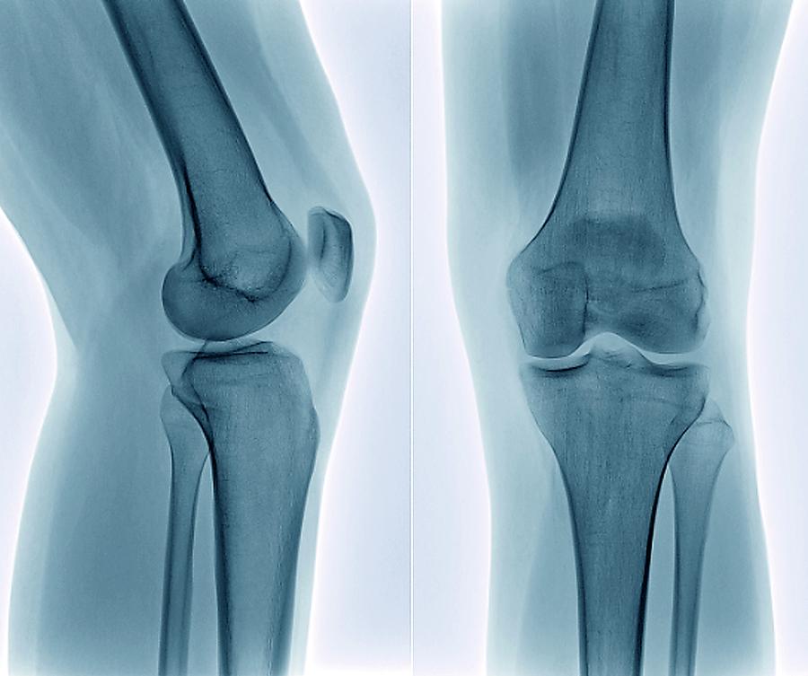 Xray Photograph - Healthy Knee #2 by Zephyr/science Photo Library
