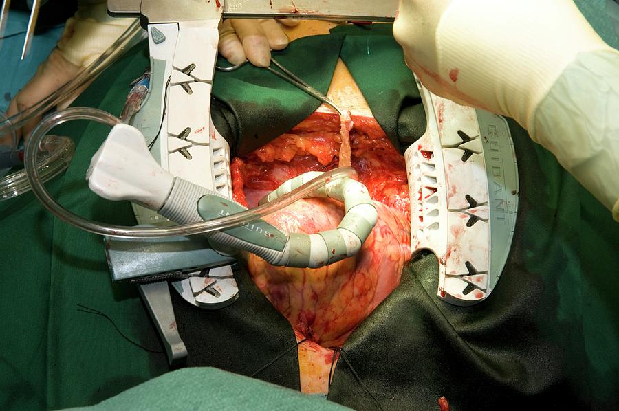 Heart Bypass Surgery Photograph by Dr P. Marazzi/science