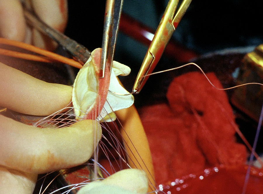 Medicine Photograph - Heart Valve Operation #2 by Steve Allen/science Photo Library