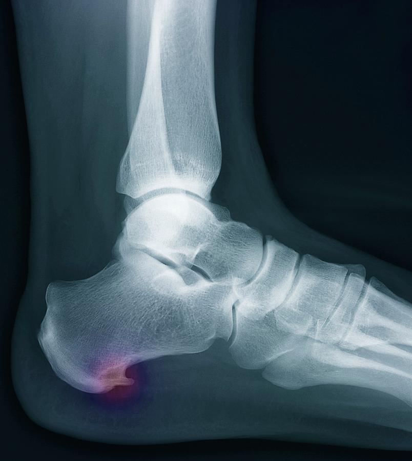 All 104+ Images bone spur on back of heel pictures Latest
