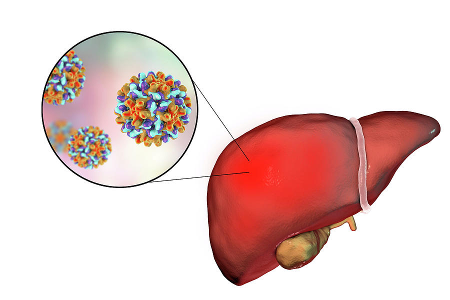 Hepatitis B Photograph By Kateryna Kon/science Photo Library | Fine Art ...