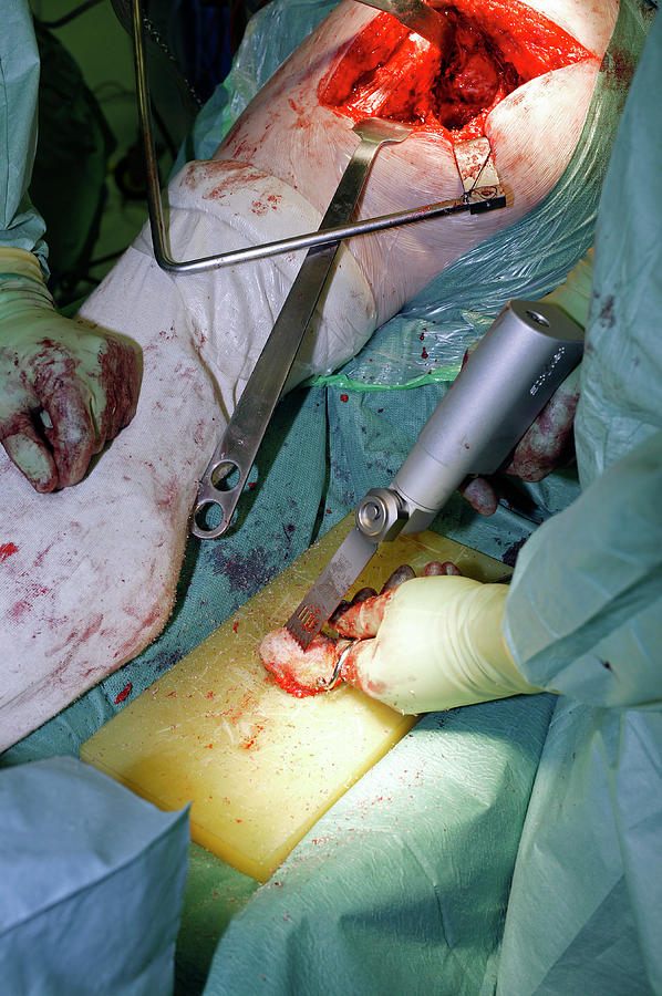 Hip Replacement Surgery Photograph by Antonia Reeve