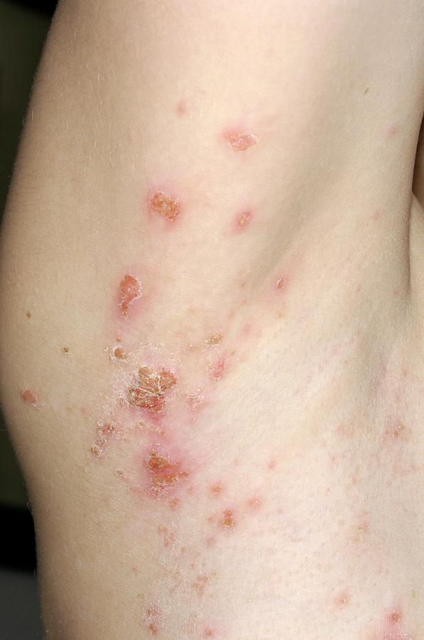 impetigo-rash-photograph-by-dr-p-marazzi-science-photo-library