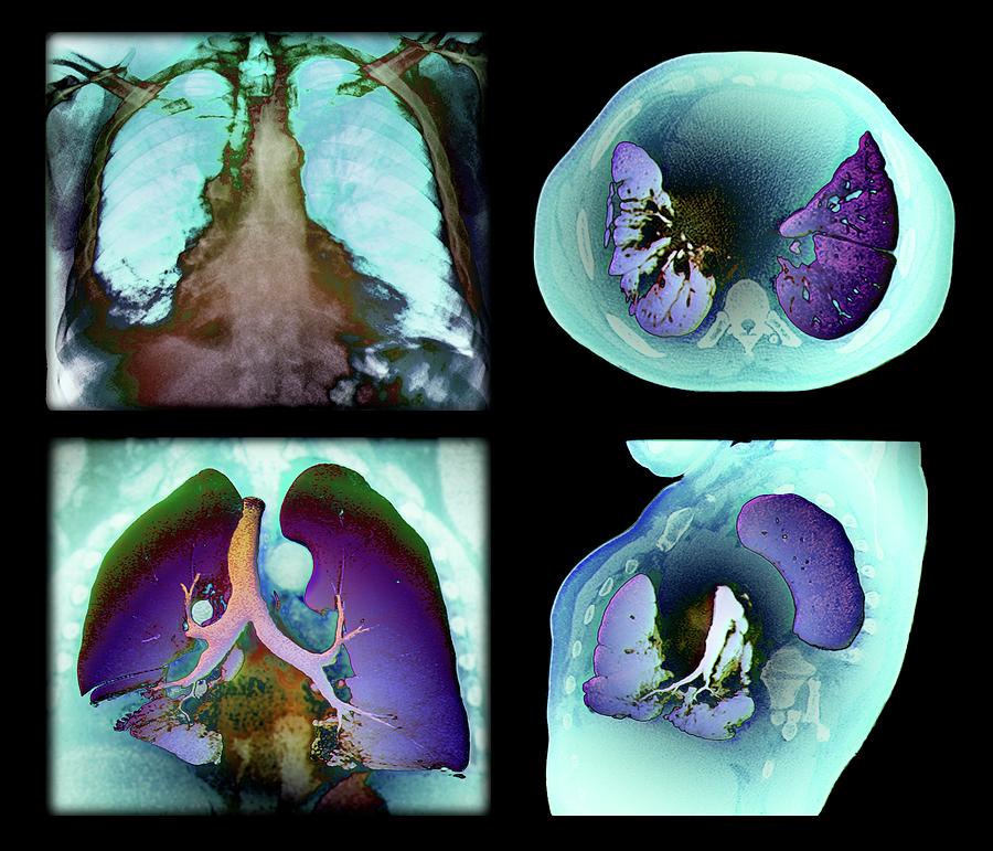 Kaposi's Sarcoma Of The Lung Photograph by Zephyr/science Photo Library ...