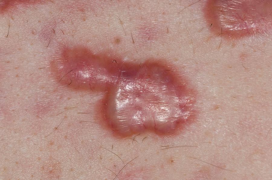 Keloid Scars In Acne Vulgaris Photograph by Dr P. Marazzi/science Photo ...