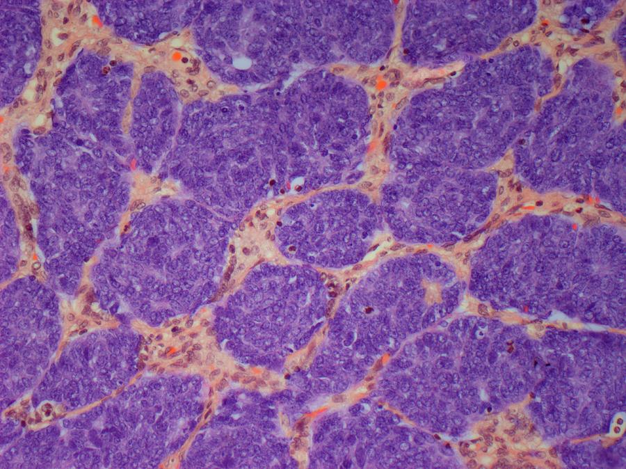 Biology Photograph - Kidney Cancer #2 by Steve Gschmeissner
