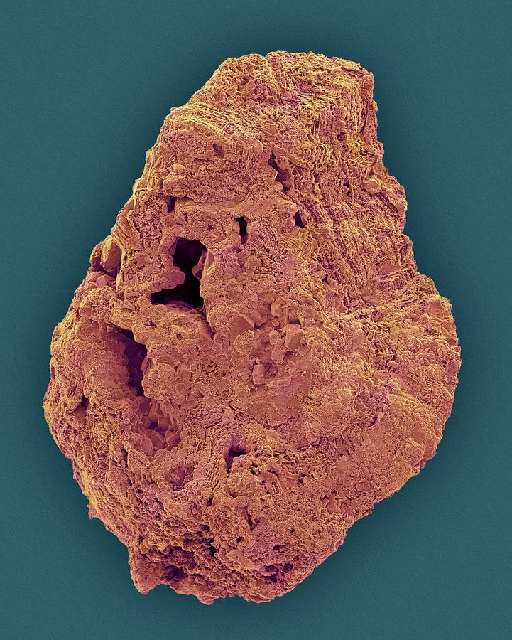 Kidney Stone #2 Photograph by Dennis Kunkel Microscopy/science Photo Library