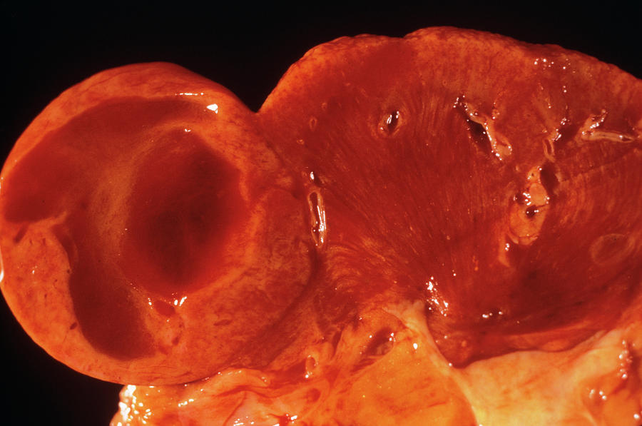 Kidney Tumour #2 Photograph by Cnri/science Photo Library