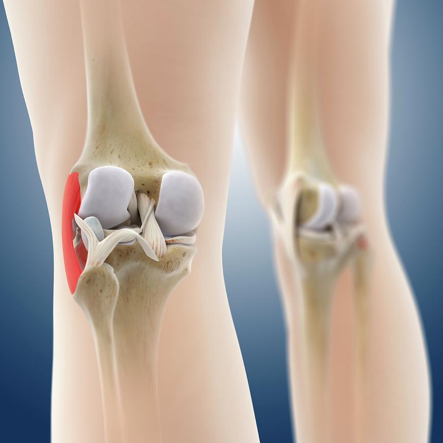 Knee Pain #2 Photograph by Springer Medizin/science Photo Library