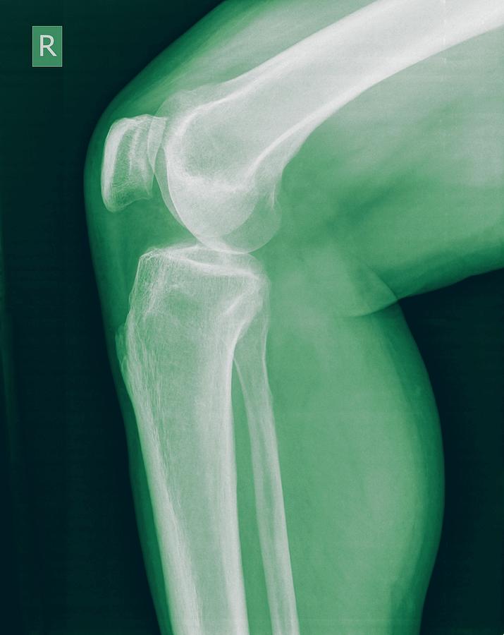 Skeleton Photograph - Knee X-ray #2 by Photostock-israel