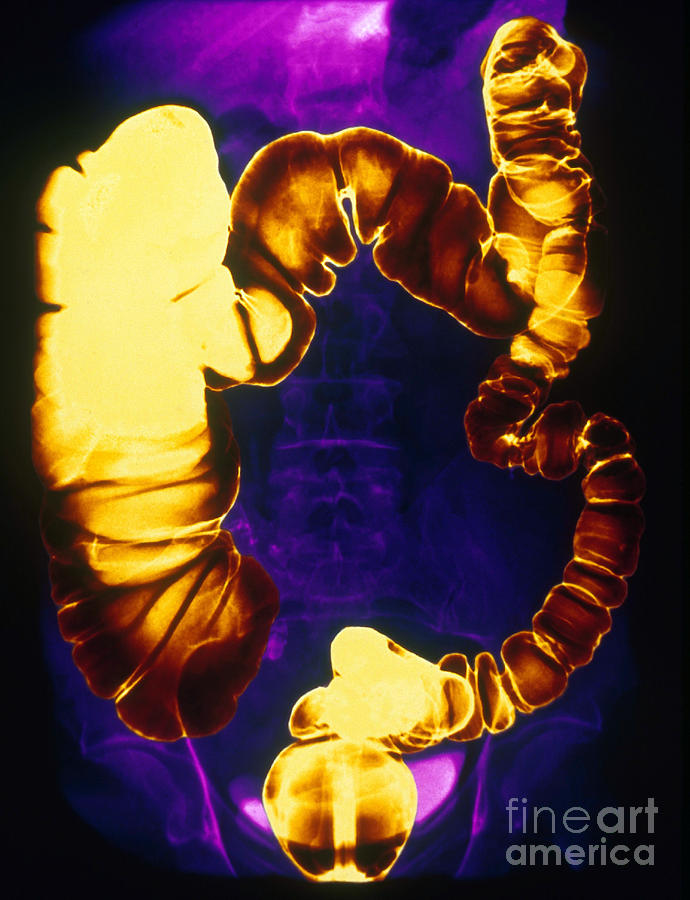 Medical Photograph - Large And Small Intestine, Barium X-ray #2 by Scott Camazine