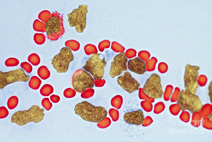 Leukemia #2 Photograph by Biology Pics