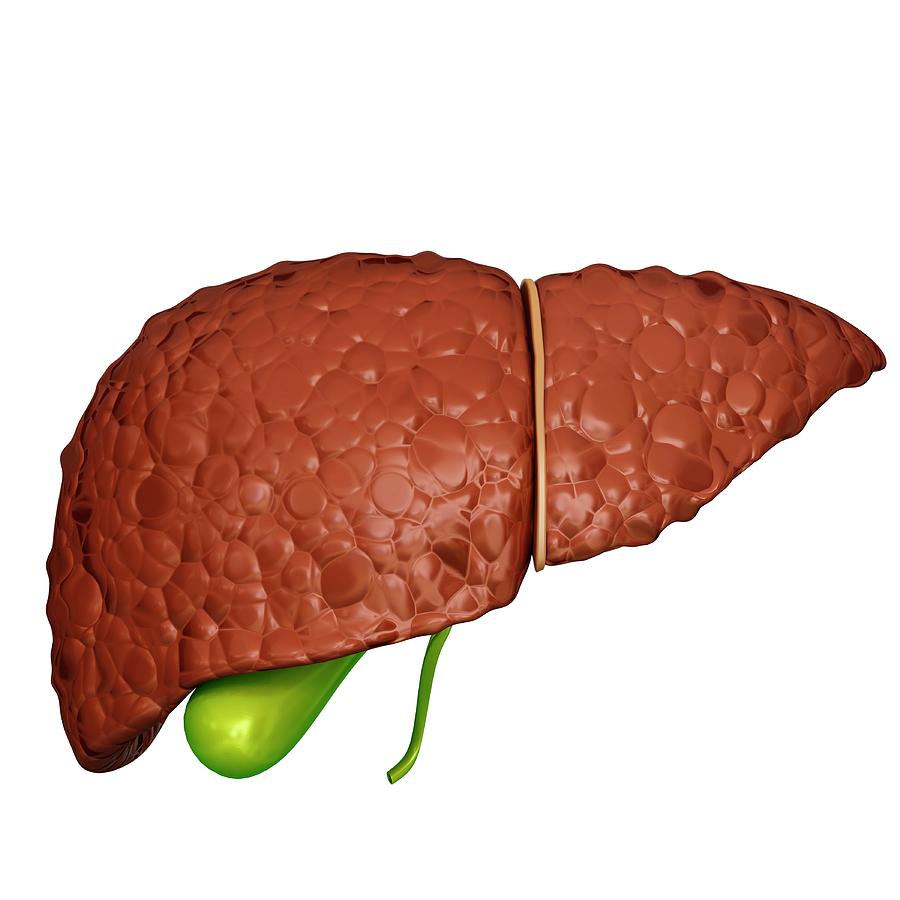 Liver Cirrhosis Photograph by Pixologicstudio - Pixels