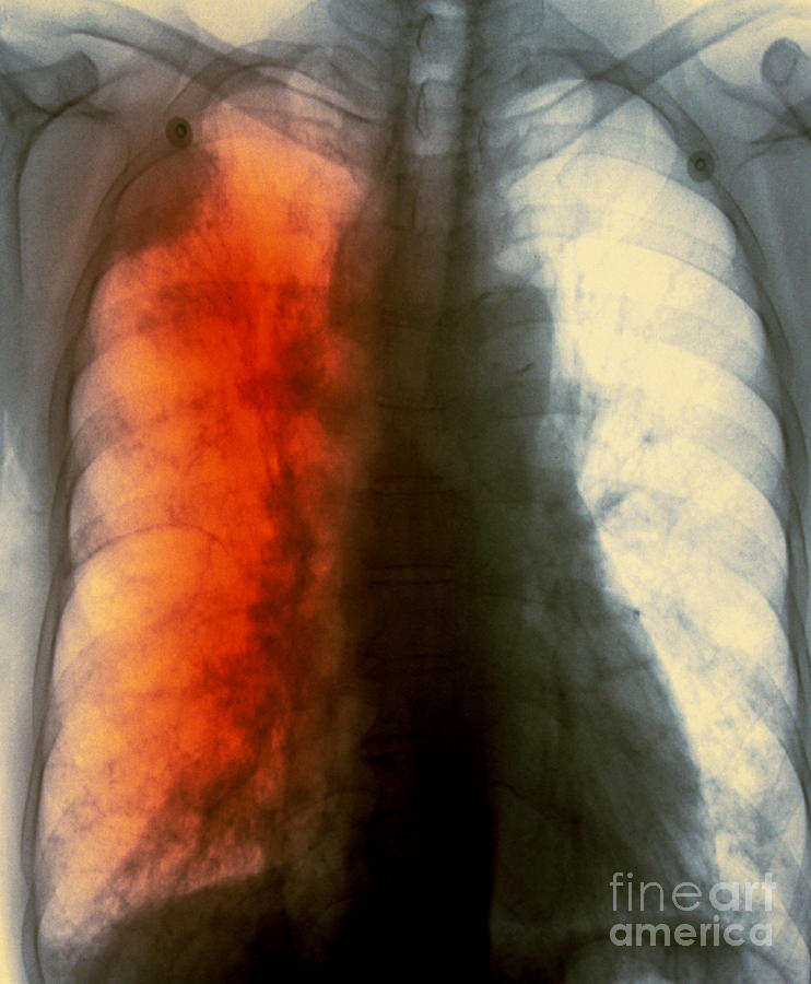 Lung Cancer X-ray #2 Photograph by Scott Camazine
