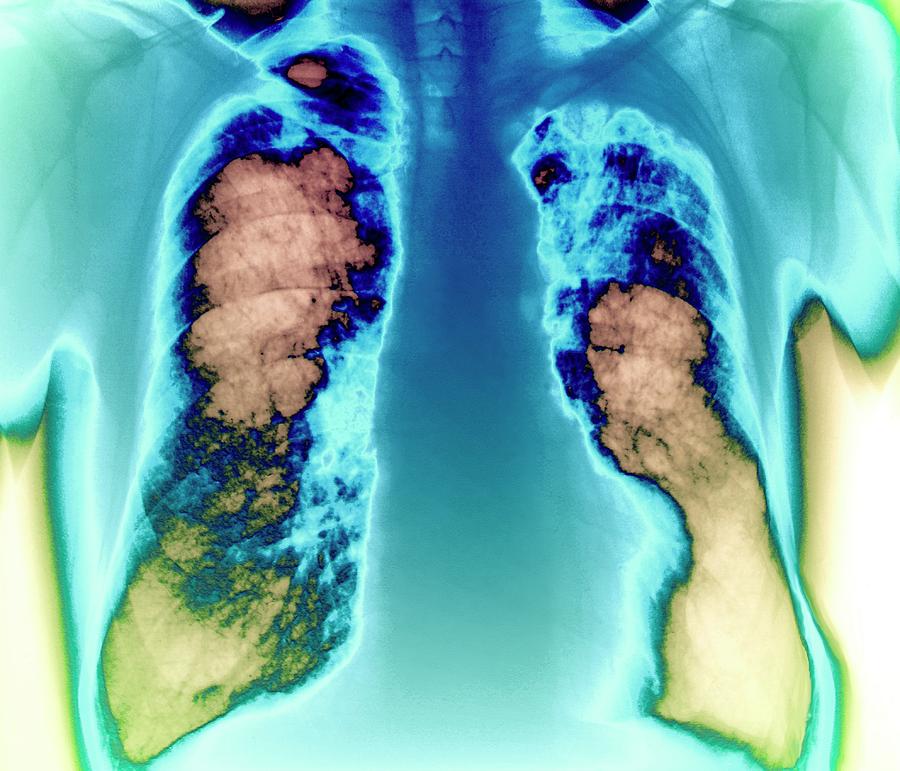 Lung Cancer #2 Photograph by Zephyr/science Photo Library